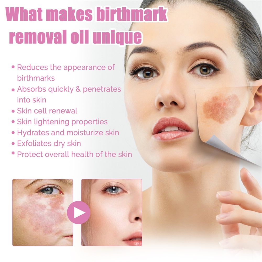 Dầu loại bỏ vết bớt EELHOE 10ml chăm sóc da