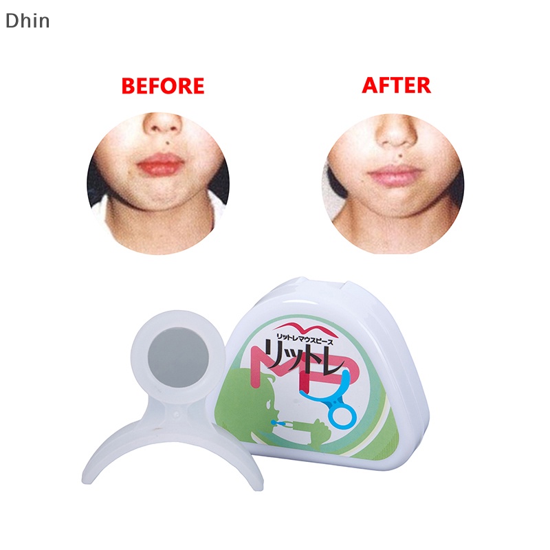 [Dhin] Nẹp Chỉnh Hình Răng Mềm Mại Chuyên Dụng