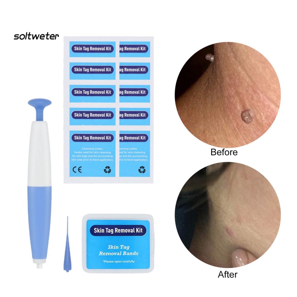 1 Bộ Dụng Cụ Loại Bỏ Mụn Cóc An Toàn Không Gây Kích Ứng Nhanh Chóng Thân Thiện Với Làn Da