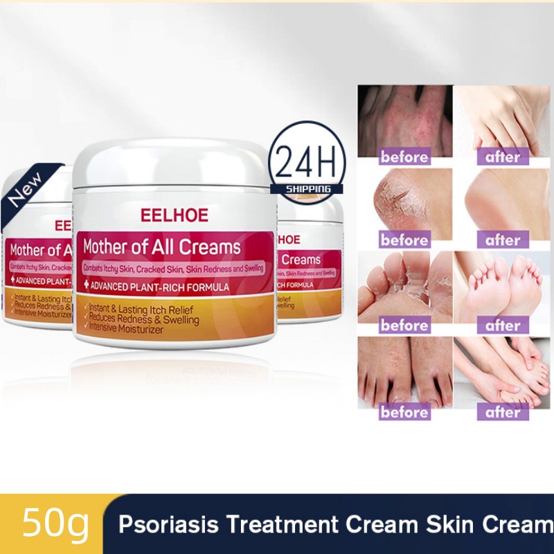 ⚡CÒN HÀNG⚡ Kem Trị Vẩy Nến Da Eelhoe Kem Trị Viêm Da Eczematoid Eczema Mỡ điều Trị Bệnh Vảy Nến Kem Chăm Sóc Da Mỡ Giảm Ngứa Da