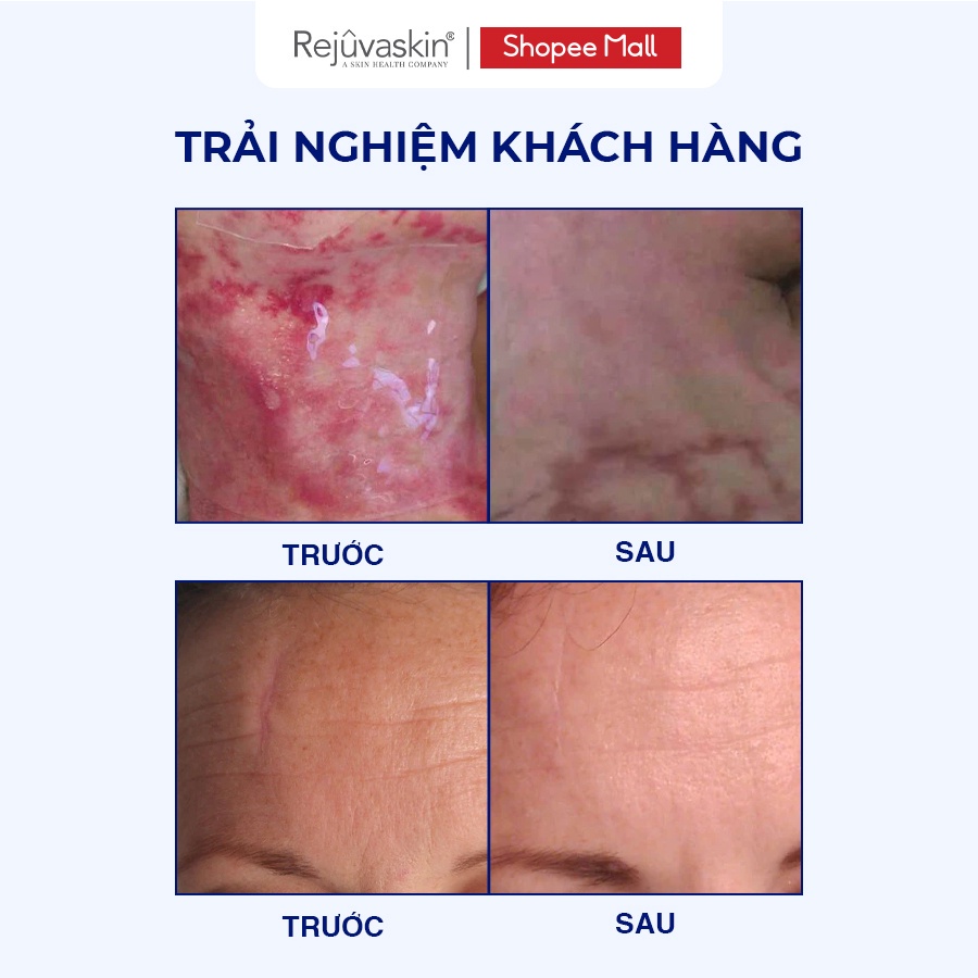 Bộ sản phẩm xóa mờ sẹo lồi Rejuvaskin Scar Heal Kit - DH Beauty