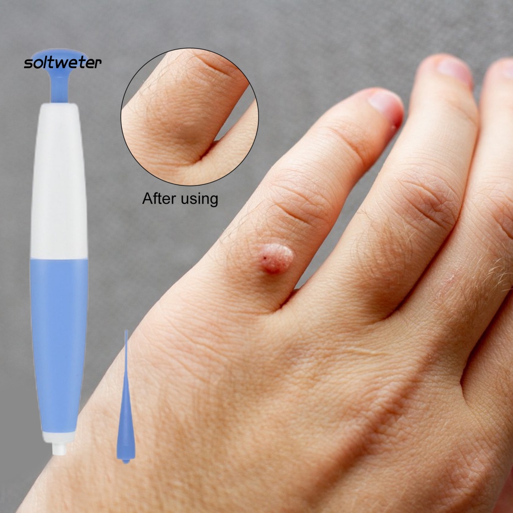 1 Bộ Dụng Cụ Loại Bỏ Mụn Cóc An Toàn Không Gây Kích Ứng Nhanh Chóng Thân Thiện Với Làn Da