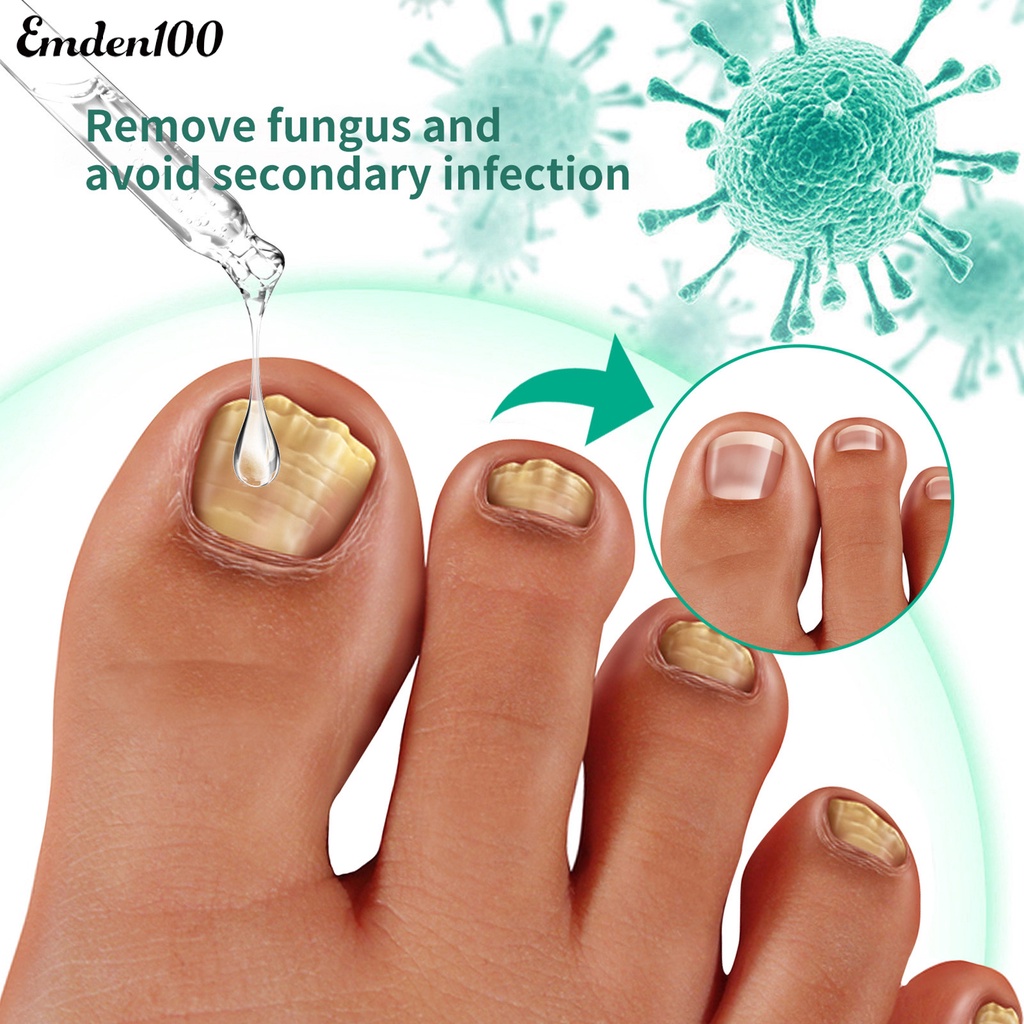 Tinh Chất Onychomycosis 30ml Hỗ Trợ Phục Hồi Móng Nhanh Chóng Và Hiệu Quả