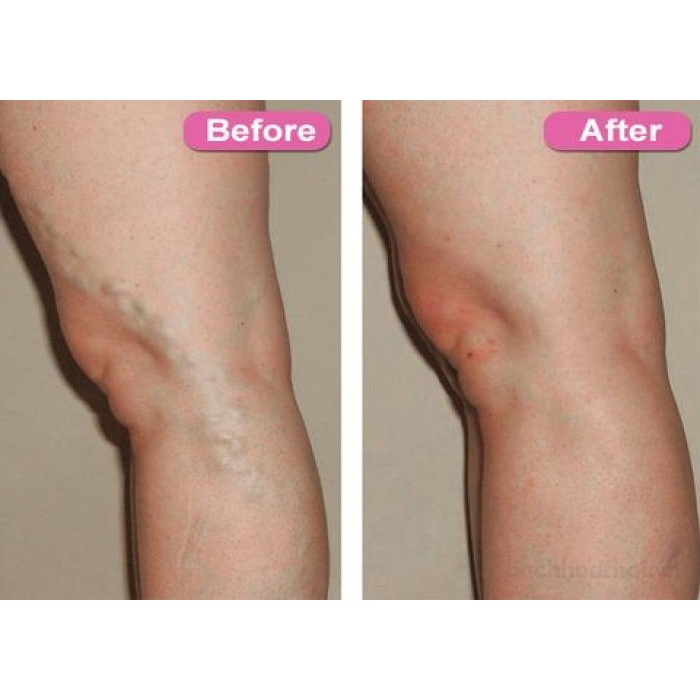 Tuýp 25g kem làm mờ rạn da do suy giãn tĩnh mạch Philosoft LegActif Cream Thái Lan