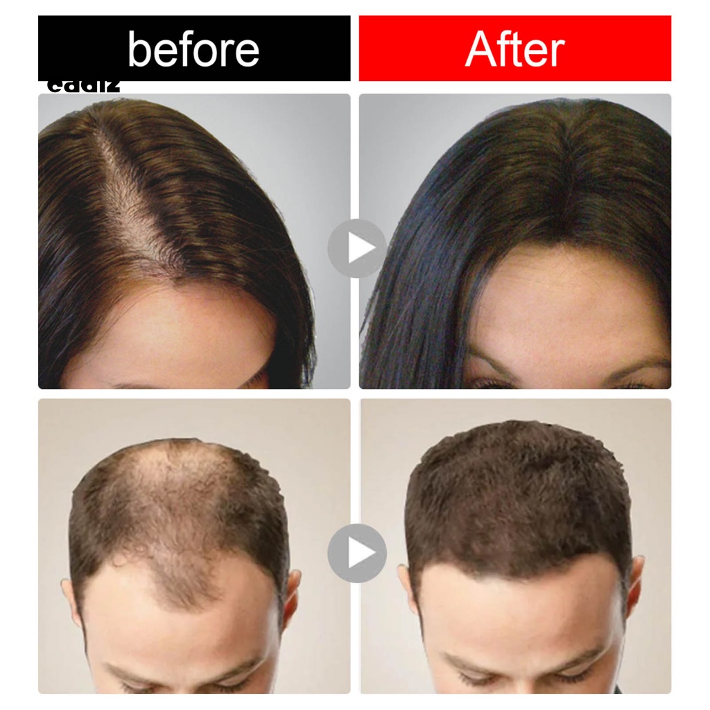 Xà Phòng Gội Đầu Chống Rụng Tóc Nhanh Chóng Không Gây Kích Ứng Cho Người Lớn