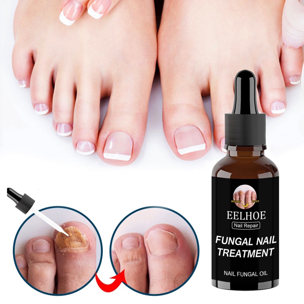 30ml '50ml Dầu dưỡng móng Eelhoe Fungal Tinh chất phục hồi chân Ngón chân Gel loại bỏ nấm móng tay Kem chống nhiễm nấm Chăm sóc móng sản phẩm 2023New