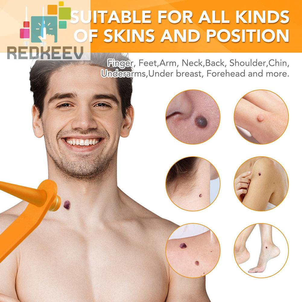 1 Bộ Dụng Cụ Loại Bỏ Mụn Cóc Hai Đầu Chăm Sóc Da