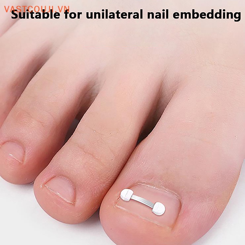 Kẹp Co Giãn Chỉnh Sửa Móng Chân Bị Cong Vnstji