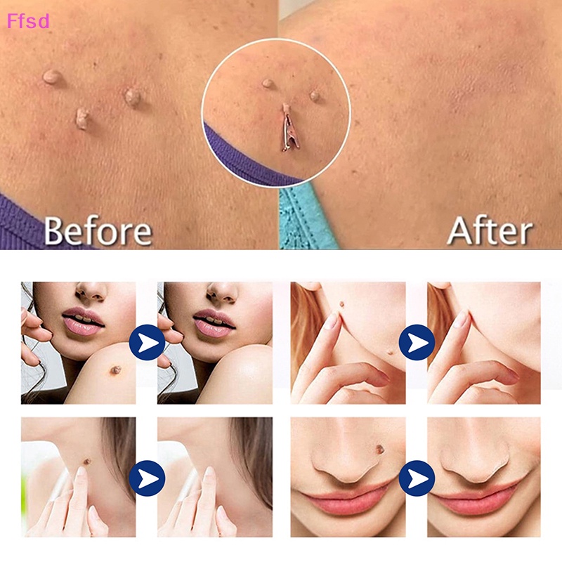 1 Dụng Cụ Kẹp Nhỏ Bằng Đồng Loại Bỏ Mụn Thịt Xăm Hình