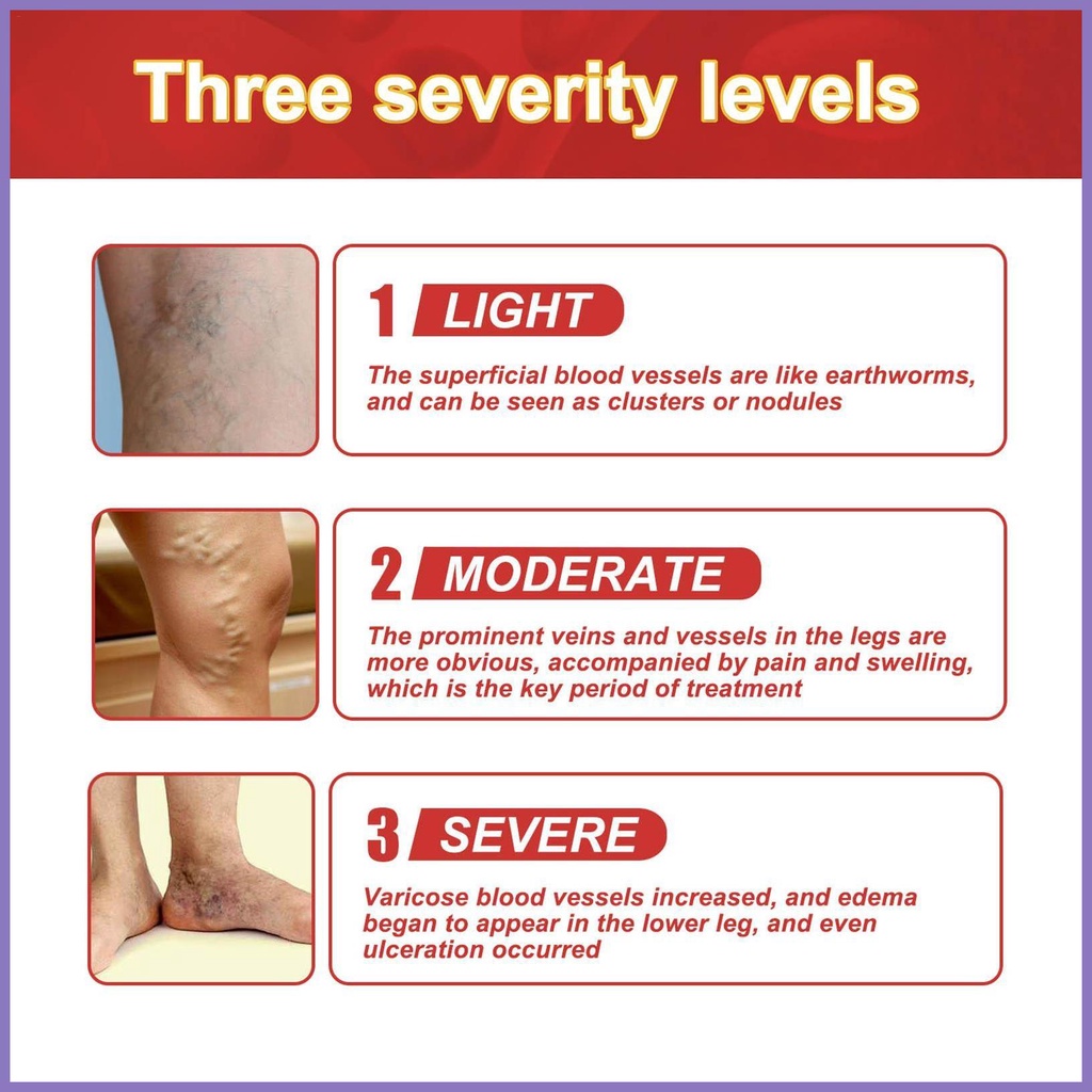 Bộ 12 Miếng Dán Giảm Giãn Tĩnh Mạch Cho Nam Nữ nota2vn