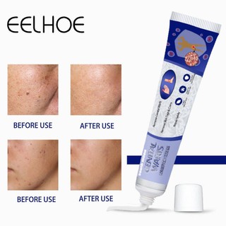Kem hỗ trợ giảm mụn cóc EELHOE SOUTH MOON 20g không gây kích ứng