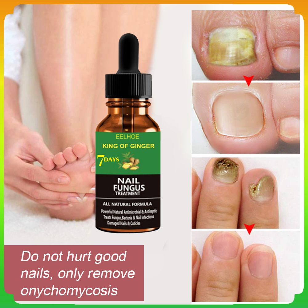 Tinh Chất Trị Nấm Móng 30 / 50ml Cao Cấp Chuyên Dụng