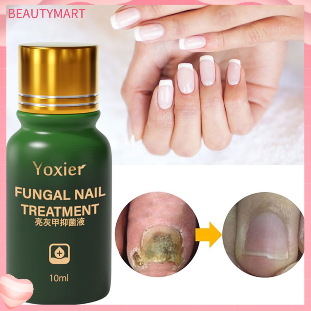 Tinh Chất Hỗ Trợ Giảm Nấm Móng Chống Nhiễm Trùng Hiệu Quả 10ml