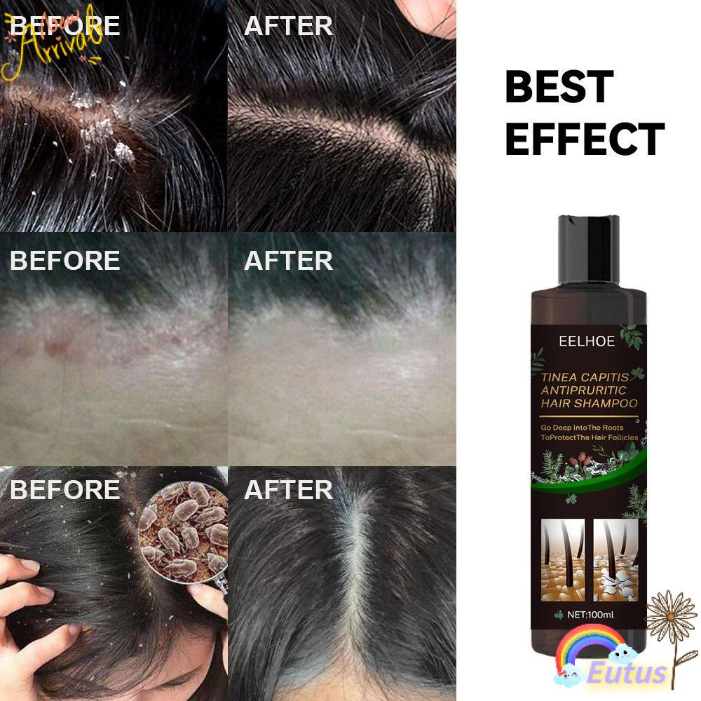 Dầu Gội Đầu Chống Ngứa Và Phục Hồi Tóc Hư Tổn