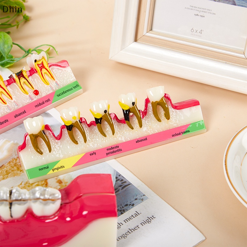 [Dhin] Mô Hình Hàm Răng Thí Nghiệm Vật Liệu Caries Research COD