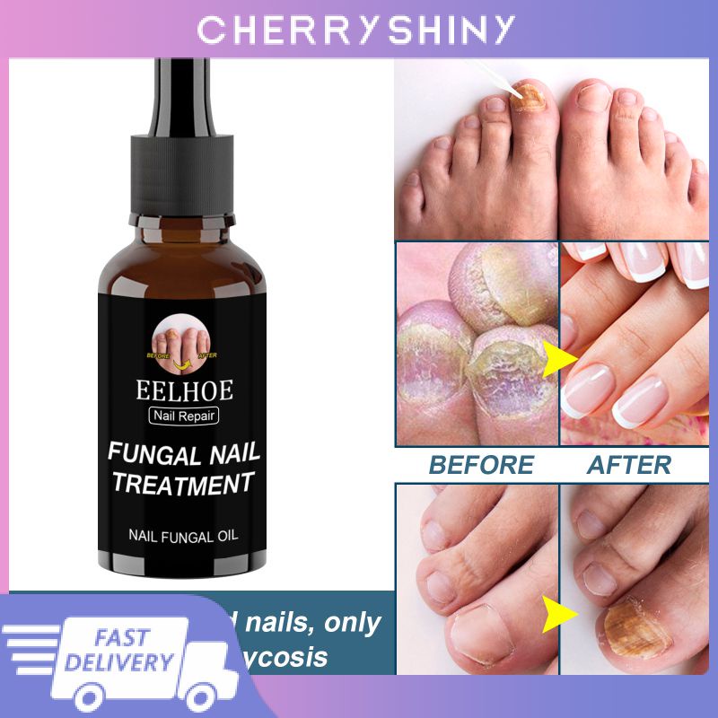 Dung dịch phục hồi nấm móng MISS ROSE Eelhoe