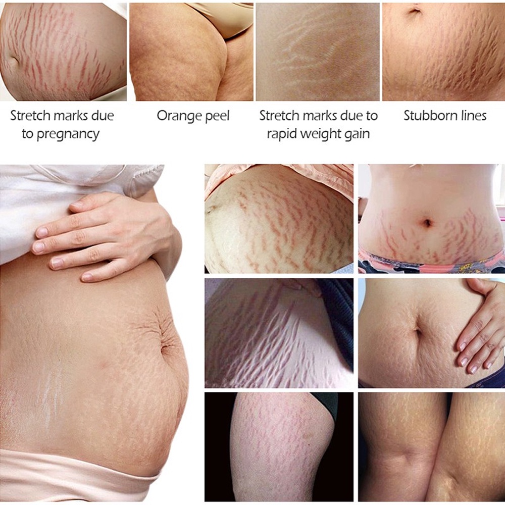 Kem hỗ trợ rạn da sau sinh, chống lão hóa VIBRANT GLAMOUR Treatment Stretch Mark 30g