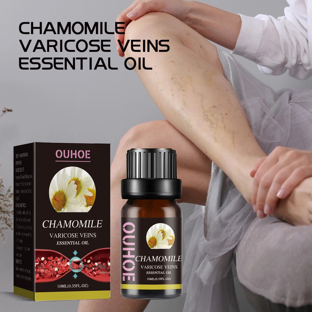 Dầu marronie cho giãn tĩnh mạch, tinh dầu hoa cúc marronie cho giãn tĩnh mạch, dầu xoa bóp điều trị giãn tĩnh mạch