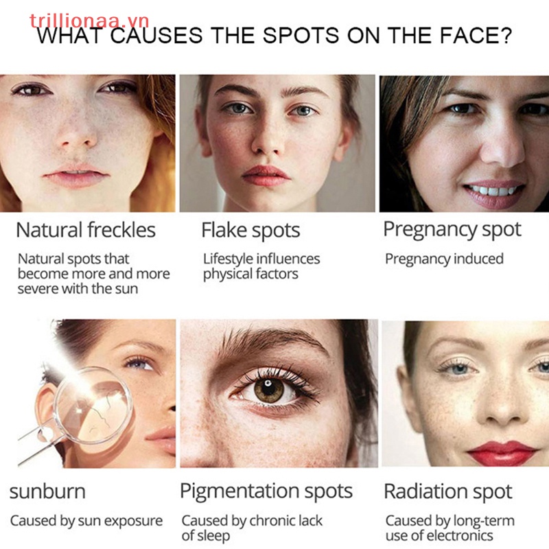 Kem Hỗ trợ giảm tàn nhang Làm Trắng Da Loại Bỏ Đốm Đen