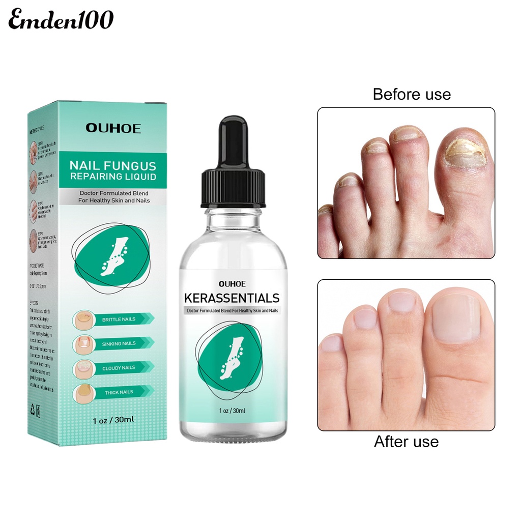 Tinh Chất Onychomycosis 30ml Hỗ Trợ Phục Hồi Móng Nhanh Chóng Và Hiệu Quả