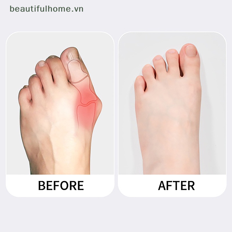 1 Dụng Cụ Định Hình Ngón Chân Cái Chăm Sóc Làm Thẳng