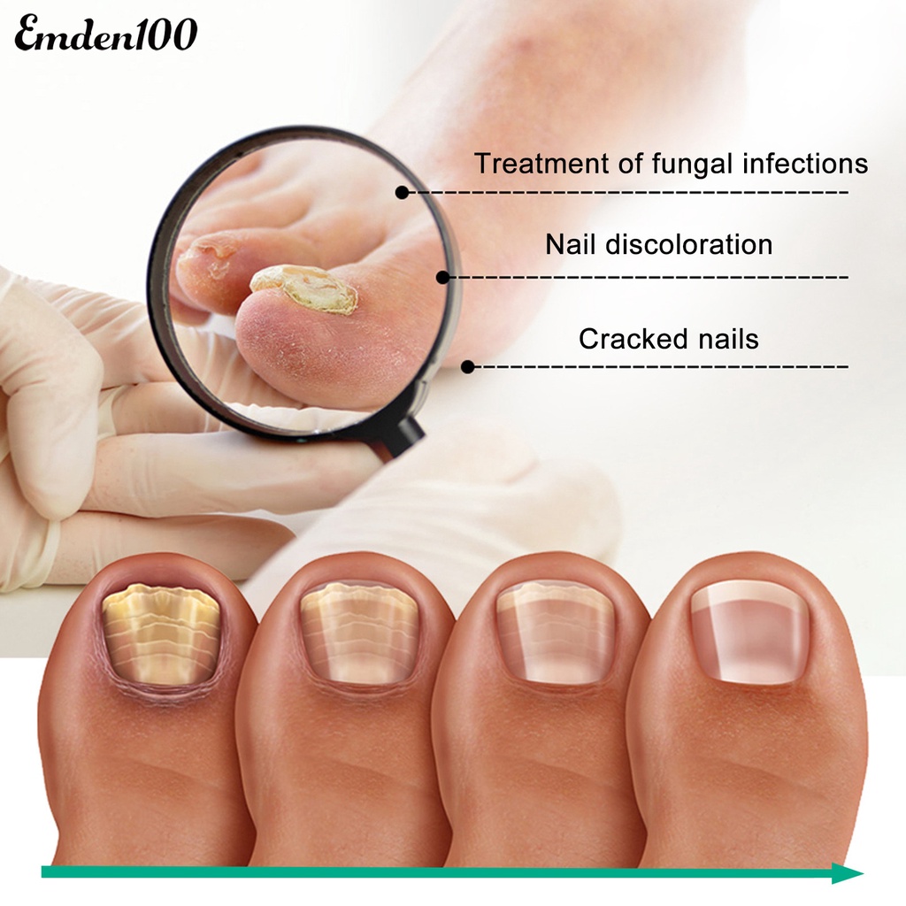 Tinh Chất Onychomycosis 30ml Hỗ Trợ Phục Hồi Móng Nhanh Chóng Và Hiệu Quả