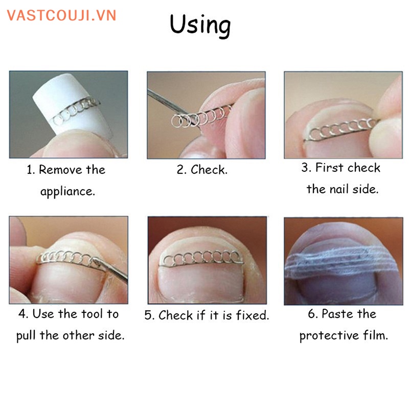 Bộ 3 Dây Cố Định Móng Chân Tiện Lợi