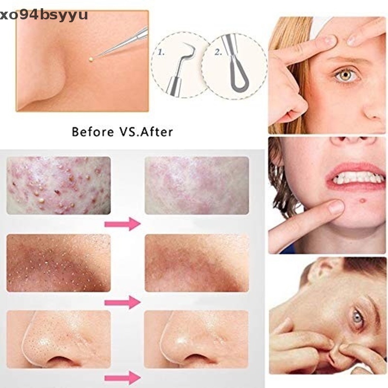 Set 9 Dụng Cụ Nặn Mụn Đầu Đen Xo94Bsyu Tiện Dụng