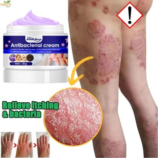 Kem ngứa da ngứa da kem kháng khuẩn chàm ngứa bong tróc viêm da herpes kem chống viêm khớp 30g tàu điện ngầm
