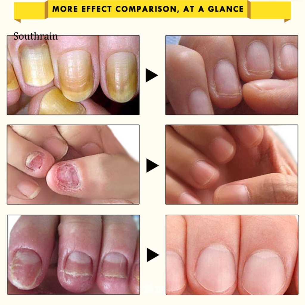 Dung Dịch Kháng Khuẩn 10ml Dễ Sử Dụng Cho Chăm Sóc Móng Tại Nhà