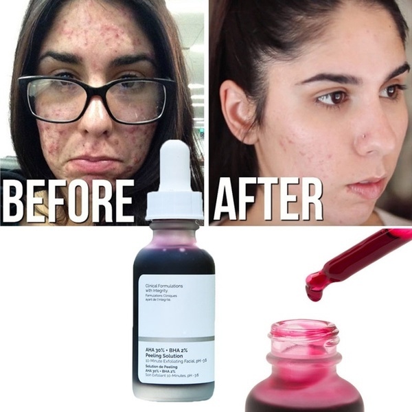 💥CHÍNH HÃNG💥  Tẩy Da Chết The Ordinary AHA 30% + BHA 2% Peeling 43