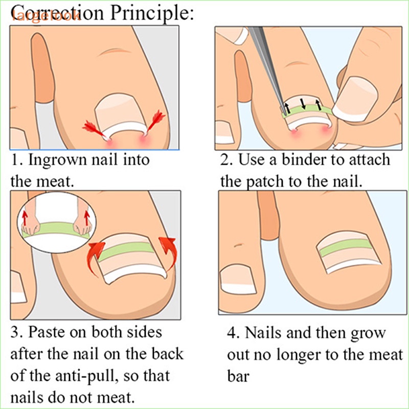 Bộ 10 Miếng Dán Chỉnh Sửa Móng Chân 13-20mm