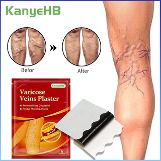 ⚡⚡COD kanyehb 9 cái giãn tĩnh mạch thạch cao sửa chữa viêm mạch viêm tĩnh mạch đau Giun đất Nhện Chân y tế vá tăng tốc lưu thông máu dán để điều trị cơ thể