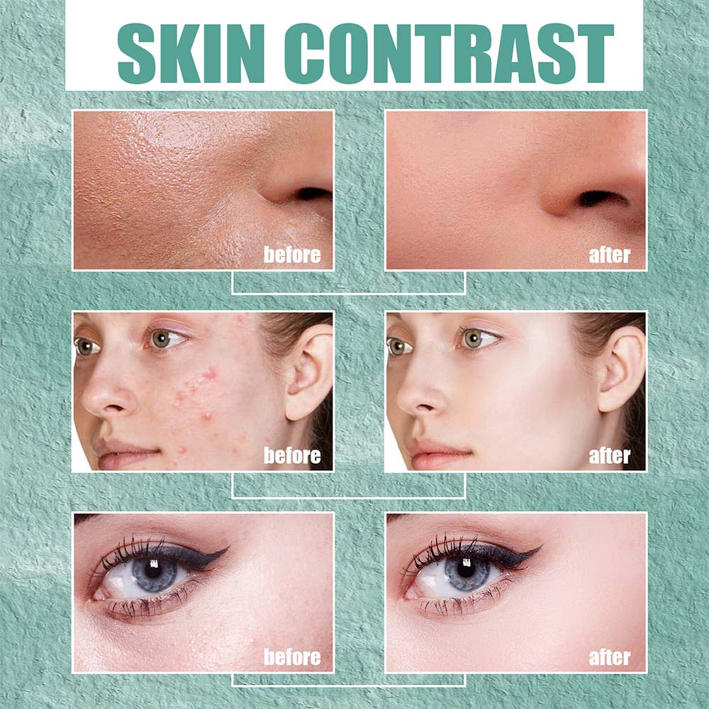 2pcs/100ml jaysuing salicylic acid cystic acne cream facial repair cream