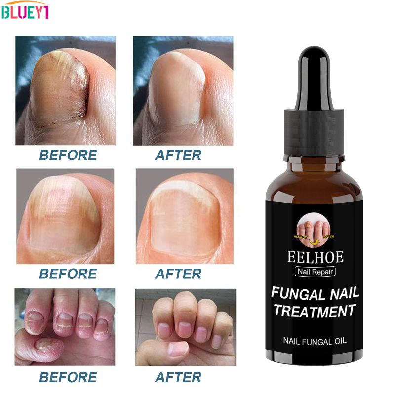 Eelhoe điều trị nấm móng tay mọc ngược móng tay giảm ban đầu ngừng tăng trưởng nấm tinh dầu màu xám chăm sóc móng tay bluey1