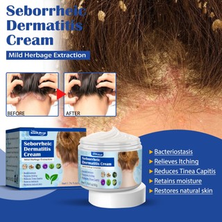 Kem trị vẩy nến mặt trăng phía Nam viêm da eczematoid eczema ngứa Thuốc mỡ kháng khuẩn kem 50g Metro