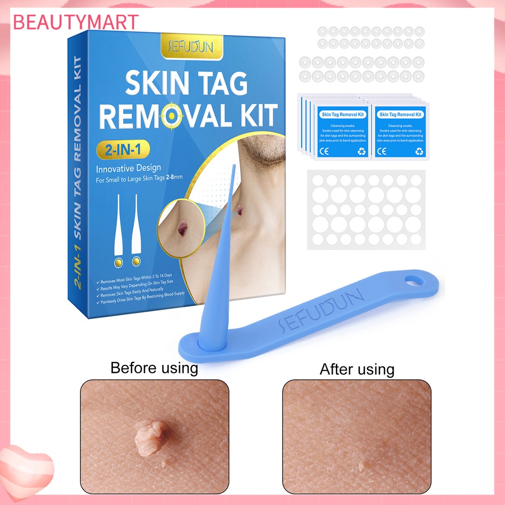 1 Bộ Dụng Cụ Loại Bỏ Mụn Cóc Trên Da Trọng Lượng Nhẹ Nhanh Chóng