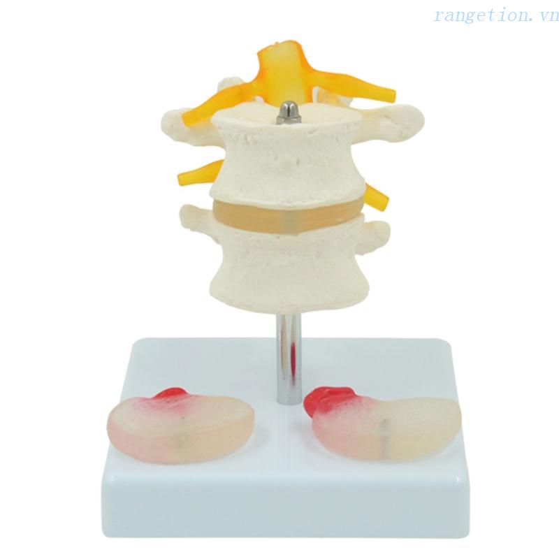 Ran Lumbar Mô Hình Di Sản Đĩa Thắt Lưng Di Sản Tháo Rời Được Cho Mô Hình Cột Sống Đường Đi Đường Dài Lumbar Vertebra