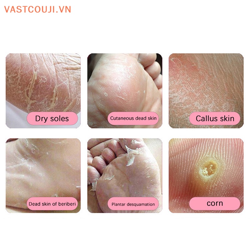 Dụng Cụ Dũa Loại Bỏ Da Chết Bằng Thép Không Gỉ Tiện Lợi