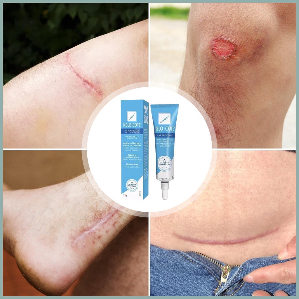 Kem xóa sẹo body scar gel loại bỏ sẹo thuốc mỡ dưỡng chất kem xóa vết rạn da cho căng da yunvn