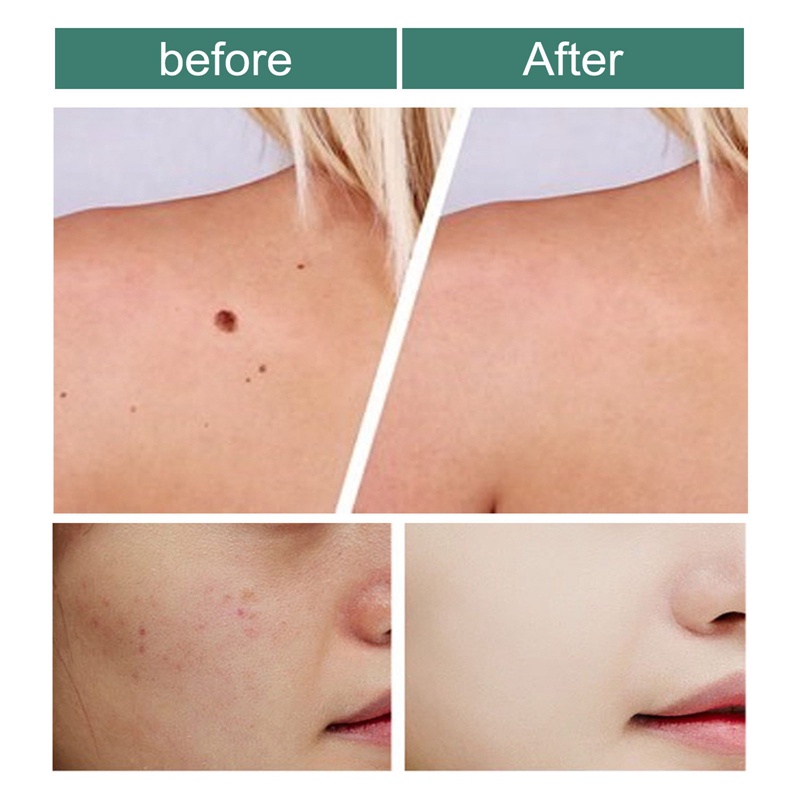 Kem Trị Vết Chai Chân 10ML Dễ Tẩy Vết Chai Giúp Loại Bỏ Chai Sạn