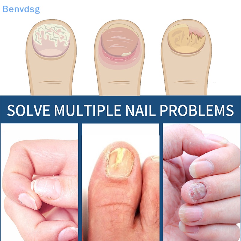 Bộ 32 Miếng Dán Chỉnh Sửa Móng Chân An Toàn