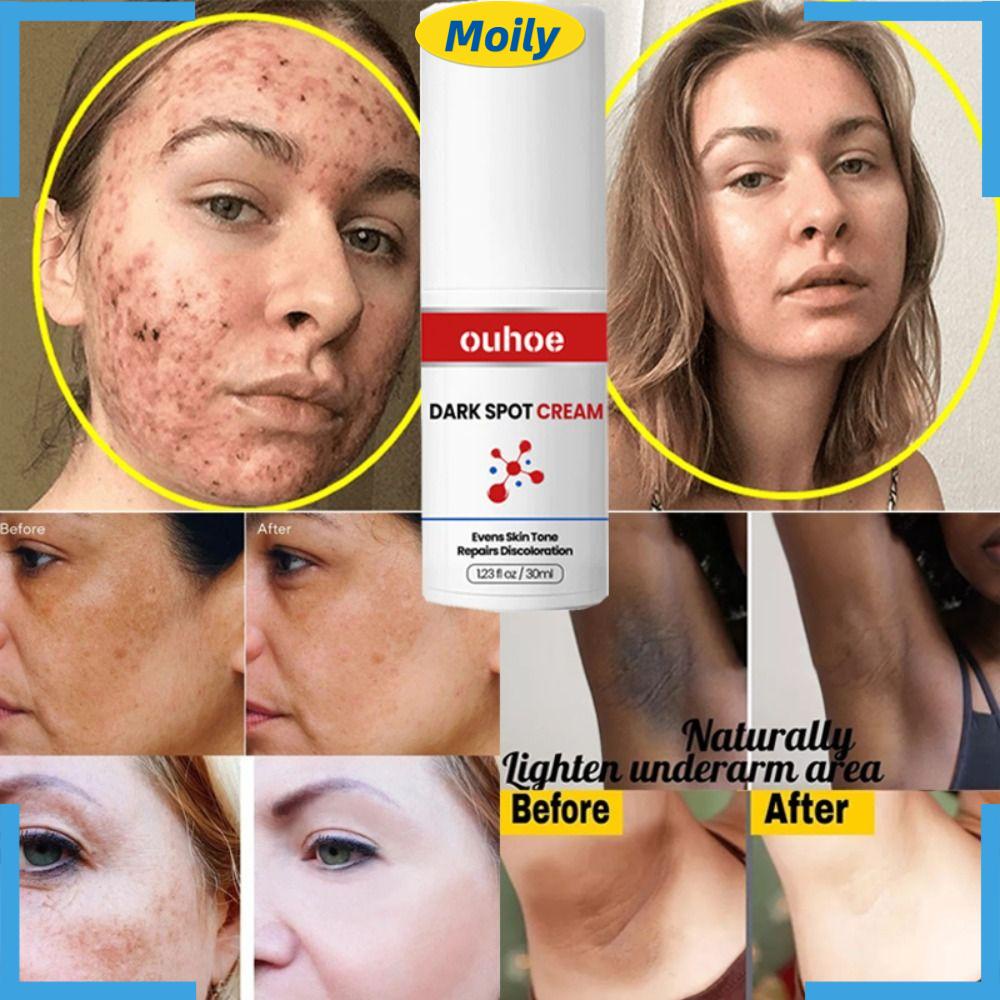 MOILYVN Kem Hỗ Trợ Giảm Tàn Nhang Đốm Đen Làm Sáng Da Hiệu Quả