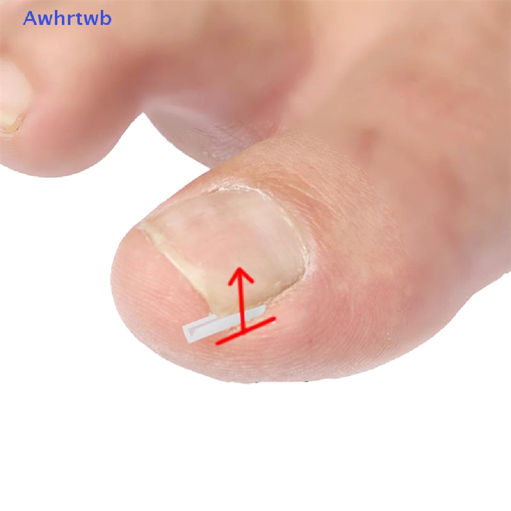 Set 10 Miếng Dán Chỉnh Sửa Móng Chân Mọc Ngược Tiện Dụng Mới