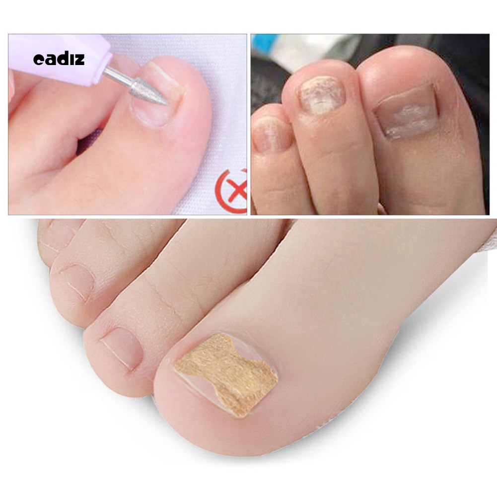Set 50 Miếng Dán Chỉnh Sửa Móng Chân Mọc Ngược Tiện Dụng