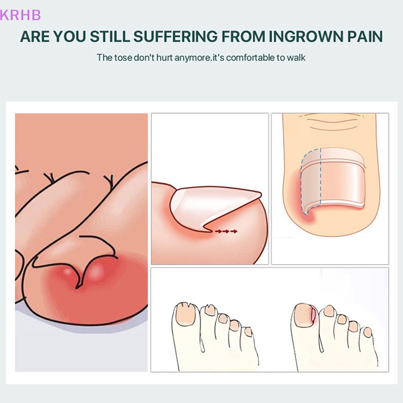 Dụng Cụ Định Hình Móng Chân Mọc Ngược Mới