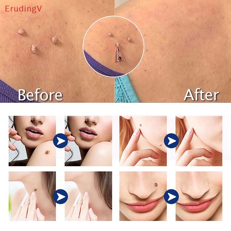 1 Dụng Cụ Kẹp Nhỏ Bằng Đồng Loại Bỏ Mụn Thịt Xăm Hình