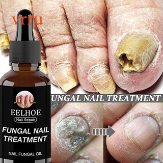 Eelhoe Nail Fungus Treatment Liquid Repair Liquid vrru