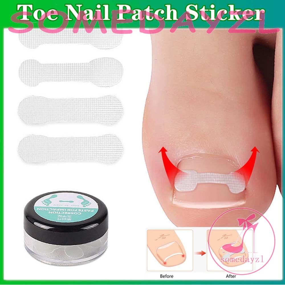 Miếng Dán Chỉnh Hình Móng Chân Mọc Ngược Hữu Dụng SOMEDAYZL Ingrown