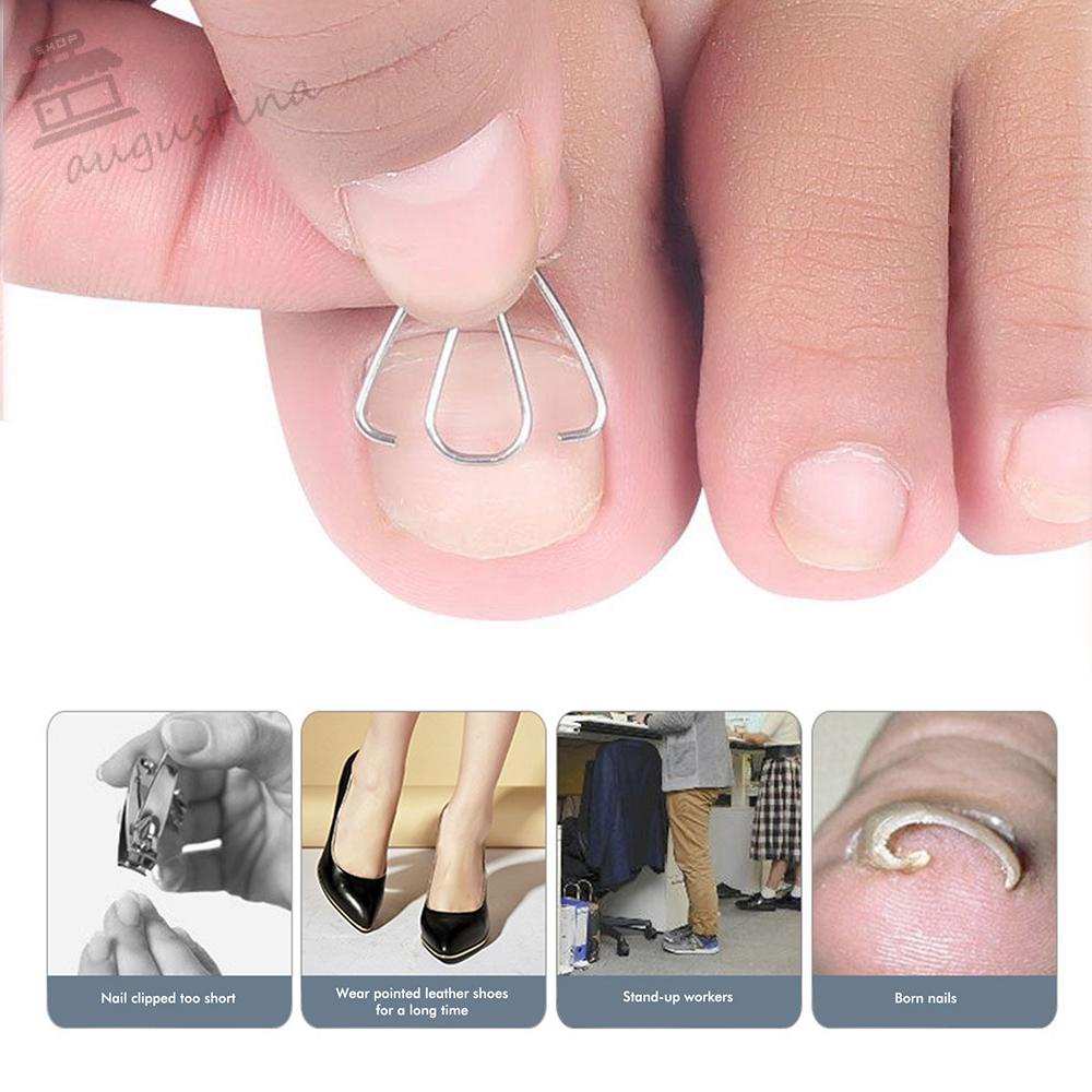 Móc Cố Định Sửa Chữa Móng Chân AUGUSTINA Bằng Thép Không Gỉ